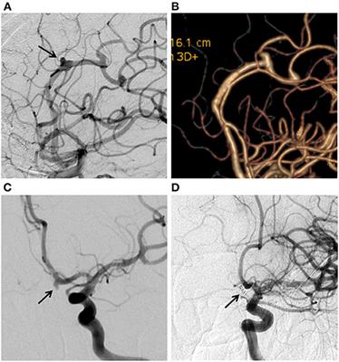 Comparison of Pipeline Embolization Device and Traditional Endovascular Therapeutic Approaches in Distal Cerebral Circulation Aneurysms Using Propensity Score Matching Analysis